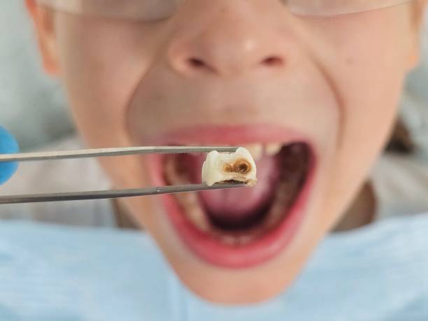 Best Emergency Treatment for Dental Infections or Abscesses in Dooms, VA